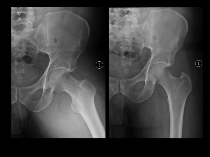 Figure 2 for case subspine impingement